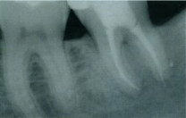 Zub s kvalitn zhotovenou koenovou vpln v stech pacienta zstv nadle s perspektivou fungovn destek let nebo dokonce doivotn.