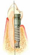 Zubn implantty se v posledn dob staly mocnm nstrojem pi een cel ady stomatologickch problm spojench se ztrtou jednoho i vce zub. 
