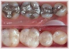 CEREC um keramick vpln (inleje) a dostavby zub (onleje)