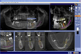 3D RTG a implantologick pln
