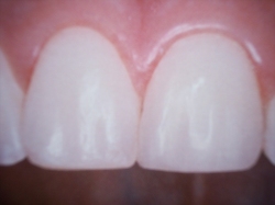 Zub po dostavbě fotokompozitem
