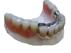 Částečné zubní náhrady se uchycují ke zbylým zubům chrupu pomocí kovových spon