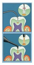 Díky technologii laserové fluorescence se zvýšila úspěšnost záchytu zubního kazu na 90%. 