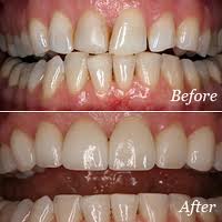 CEREC Estetick fasety
